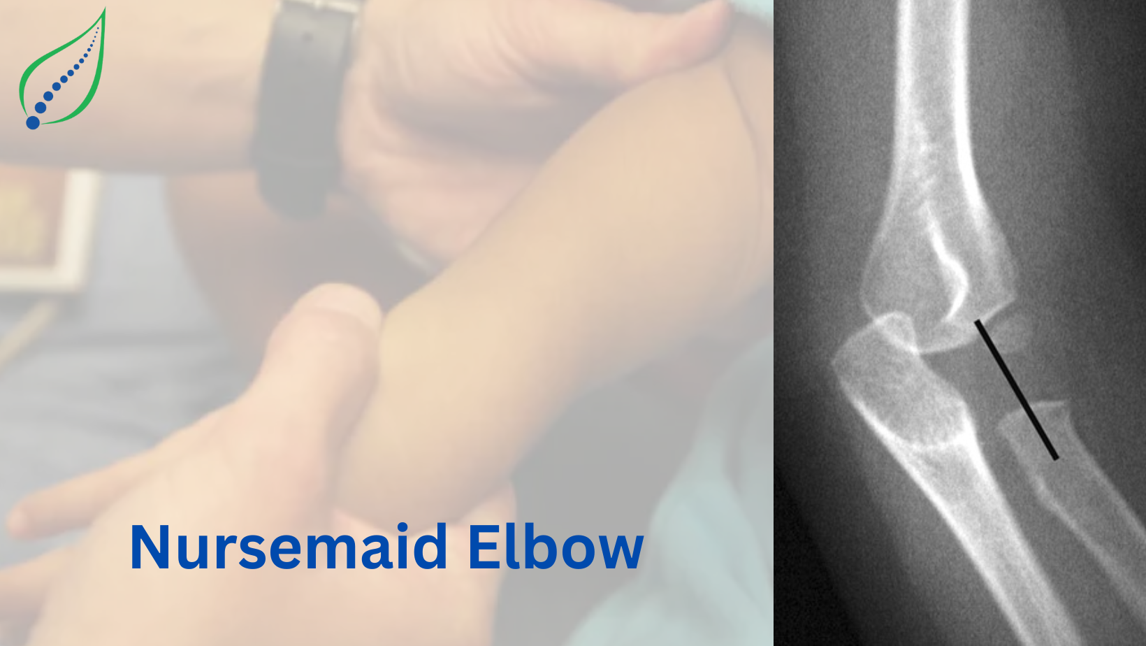Nursemaids elbow